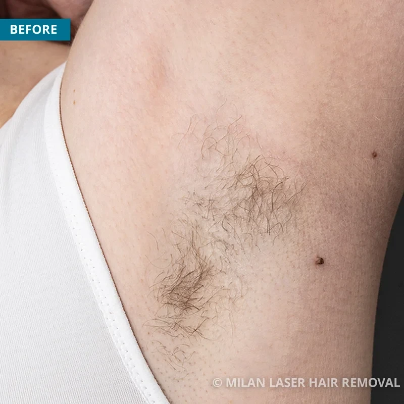 Underarm Before & After Photos of Laser Hair Removal | Milan Laser in  Southington, CT